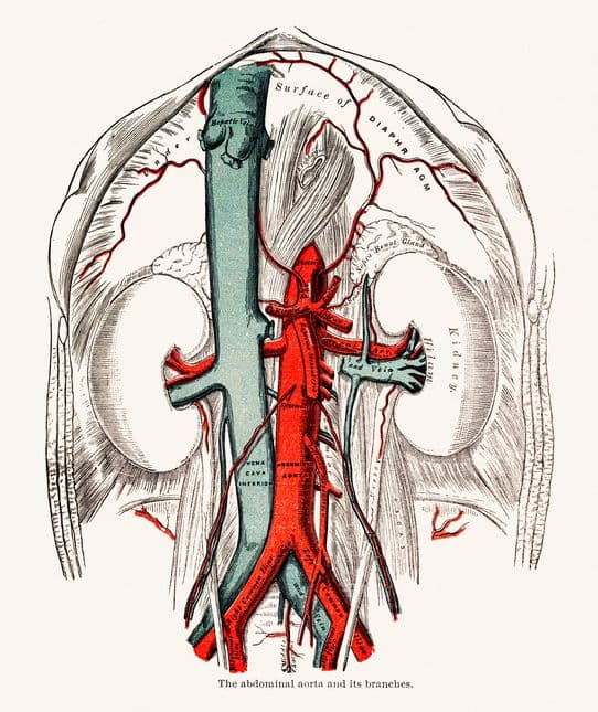 Vena cava tumor trombe, robotassistert laparoskopisk eksisjon